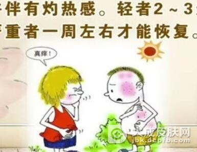 日光性皮炎会很严重吗