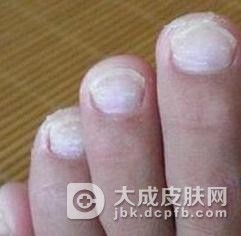 趾断症的临床表现都是什么