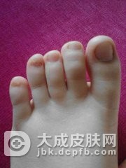 趾断症的发病的表现是什么