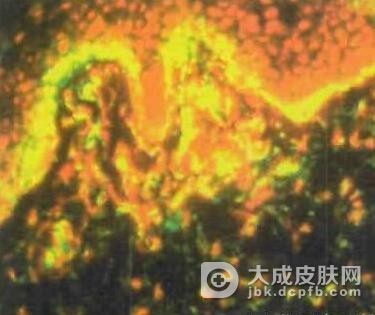 副银屑病怎么办好