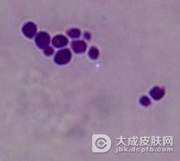儿童念珠菌病的症状是什么呢