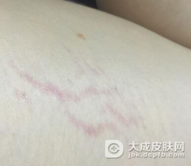 萎缩纹的症状表现有哪些