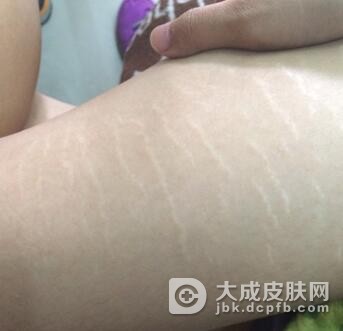 萎缩纹的诊断标准有哪些呢