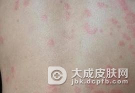 怎样的预防接触性荨麻疹