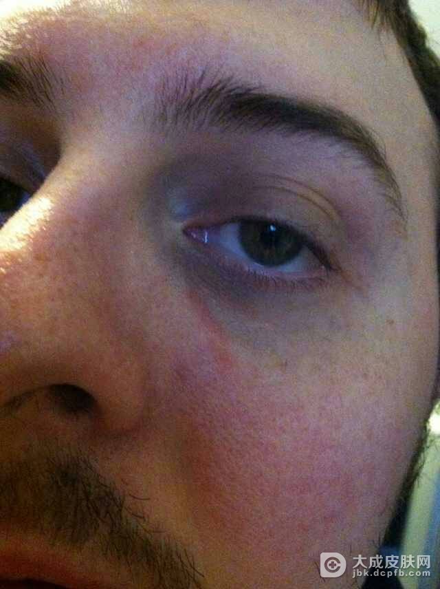 酒渣鼻如何有效预防复发？