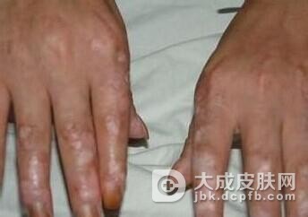 传染性红斑要怎样护理