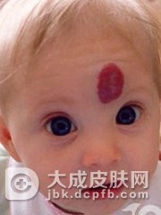 大人有鲜红斑痣会不会遗传给小孩