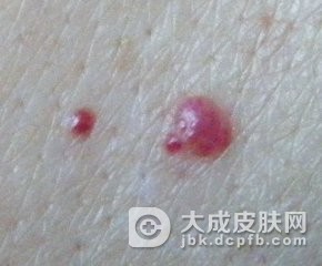 平时爱吃辣会加重鲜红斑痣的颜色吗