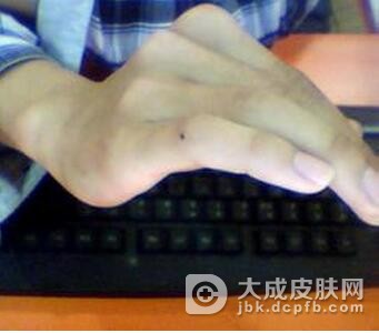 恶性黑色素瘤的发生特点是什么呢