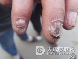 关于肠病性肢端皮炎的护理方法