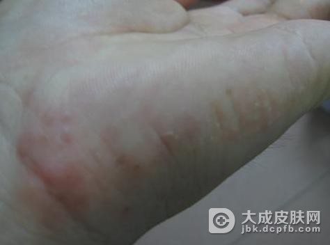 汗疱疹是如何产生的