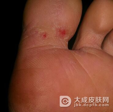 脚上长跖疣怎么治疗