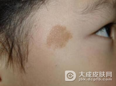 咖啡斑治疗方法的简要认识