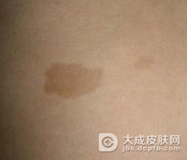 如何治疗宝宝咖啡斑