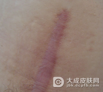 疤痕的外观分类有哪些