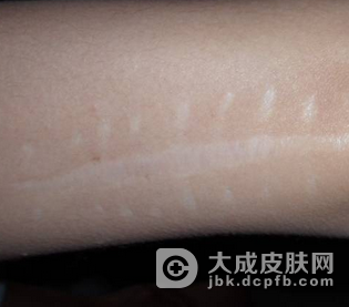 疤痕的处理方法有哪些