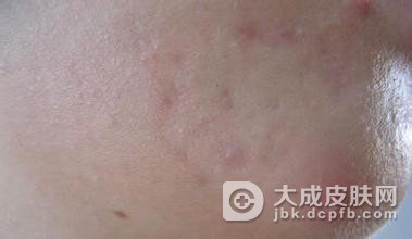 青春痘疾病日常护理
