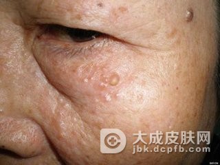 黄瘤病的饮食的护理