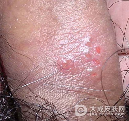 生殖器官疱疹复发是因为那些原因