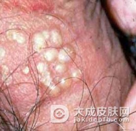 生殖器疱疹的治疗误区有哪些