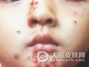 单纯性疱疹怎么治会有好的效果