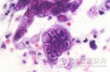 单纯疱疹可以治好的吗