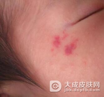 蔓状血管瘤什么