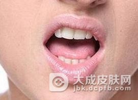 什么样原因会导致了粘膜白斑