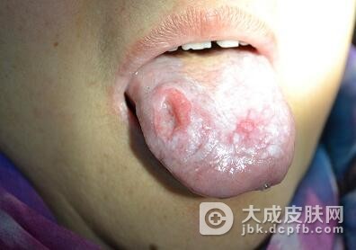中医治疗舌扁平苔藓的方法是什么呢