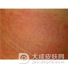 传染性湿疹样皮炎怎样的诊断