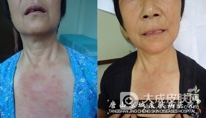 传染性湿疹样皮炎到底是什么