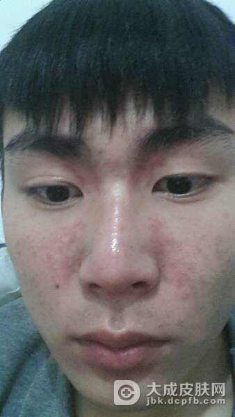 皮肤过敏该怎么办