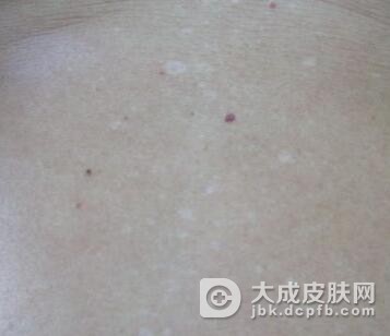 老年性白斑的发病特点是什么