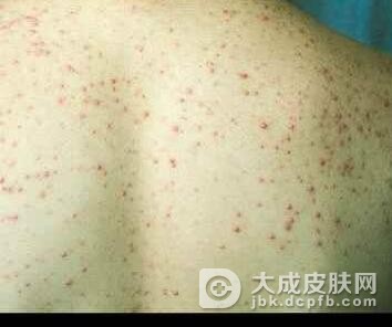 糠秕孢子菌毛囊炎的两大预防措施是什么