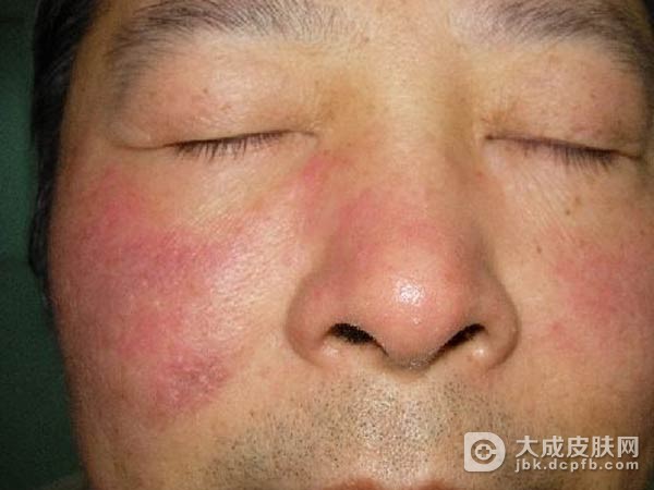 接触性皮炎怎样治疗好