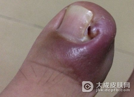 如何有效预防甲沟炎