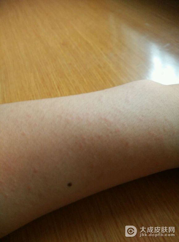 急性荨麻疹症状是什么