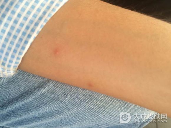 急性荨麻疹怎样防止加重