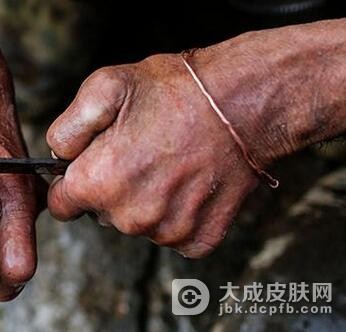 麻风患者脱发的原因有哪些呢