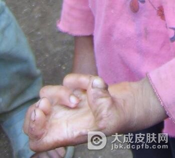 如何在早期诊断麻风病
