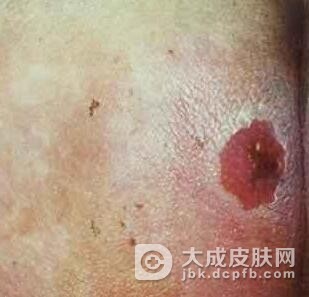 预防痈的措施是什么呢