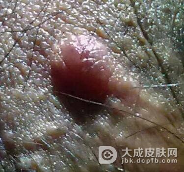 中医治疗阴囊湿疹的方法有哪些
