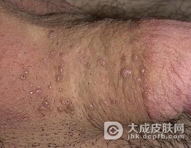 男性尖锐湿疣的护理措施