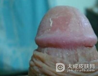 男性尖锐湿疣初期症状是什么样的呢