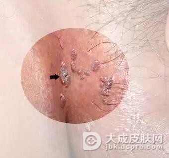 男性尖锐湿疣较主要的传播方式是什么