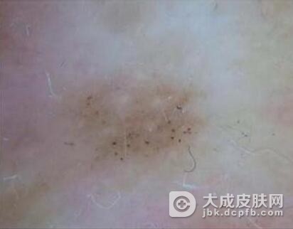 介绍皮肤纤维瘤的典型症状