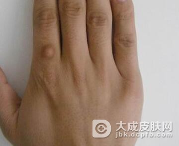皮肤纤维瘤是怎样形成的
