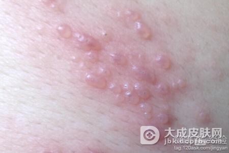 生殖器疱疹对于女性的危害