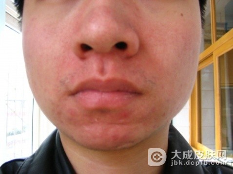 引起放射性皮炎是什么原因