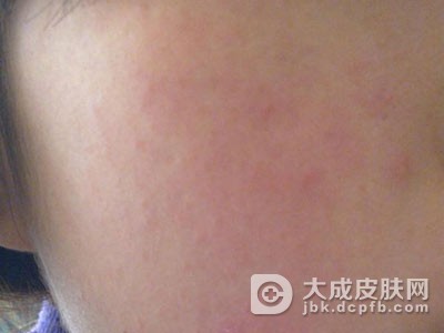 放射性皮炎的症状有哪些